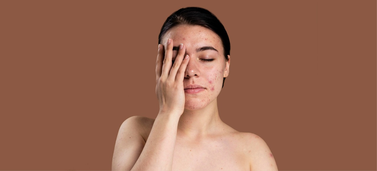 Acne Is Gone—So Why Is the Mark Still There?